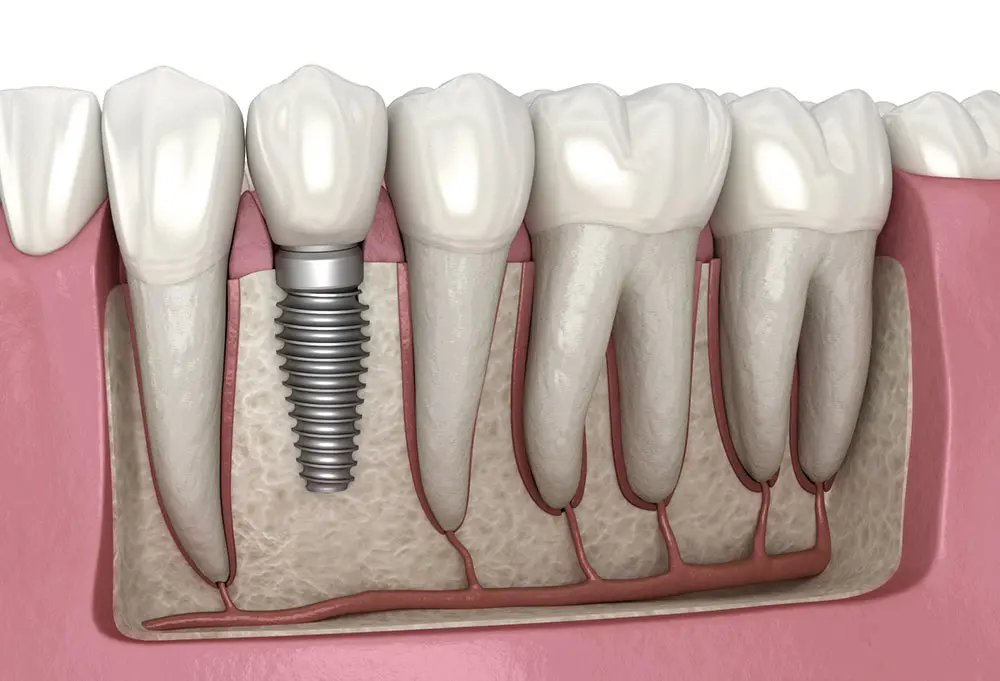 Everything You Need to Know About Dental Implants
