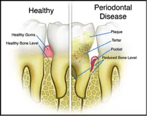 Diagram showing the difference between healthy teeth and those affected by Periodontal disease